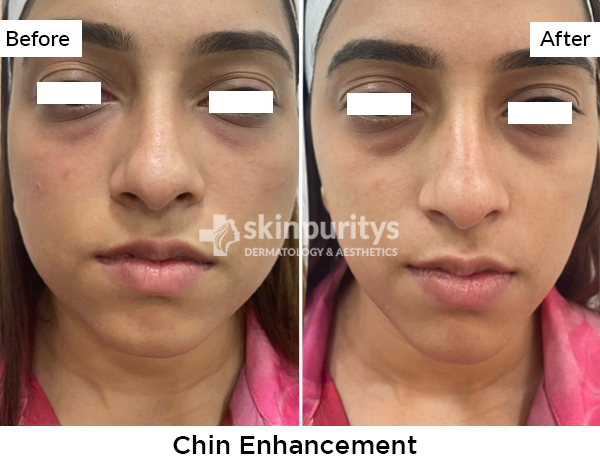 Chin Enhancement results